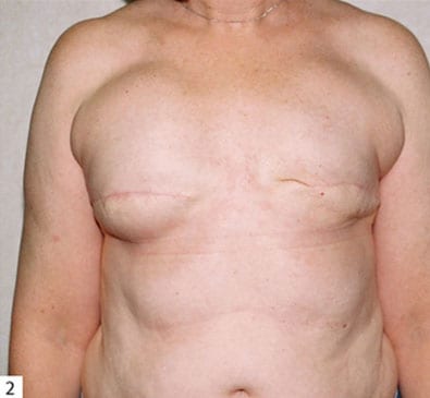 Breast Reconstruction 05 After Photo