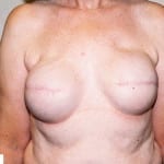 Breast Reconstruction 05 Before Thumbnail Photo