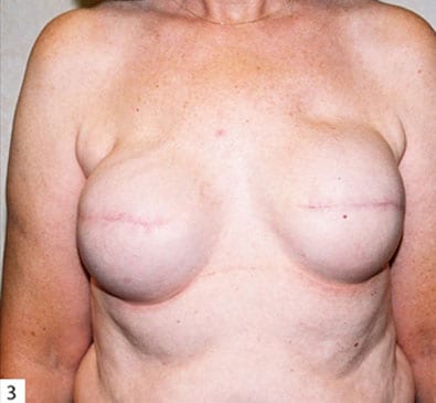 Breast Reconstruction 05 Before Photo