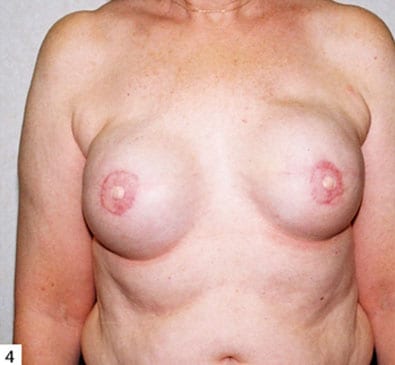 Breast Reconstruction 05 After Photo