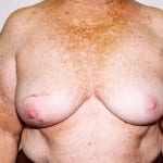 Breast Reconstruction 06 Before Thumbnail Photo