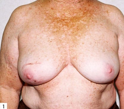 Breast Reconstruction 06 Before Photo