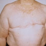 Breast Reconstruction 06 After Thumbnail Photo