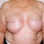 Breast Reconstruction 06 Before Thumbnail Photo
