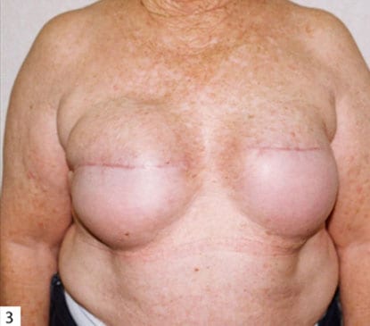 Breast Reconstruction 06 Before Photo