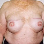 Breast Reconstruction 06 After Thumbnail Photo