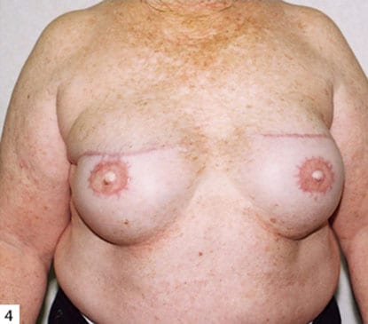 Breast Reconstruction 06 After Photo