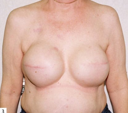 Breast Reconstruction 07 Before Photo