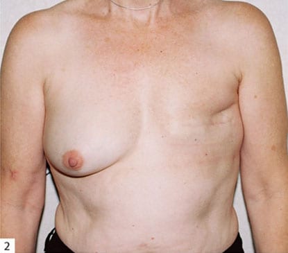 Breast Reconstruction 08 After Photo