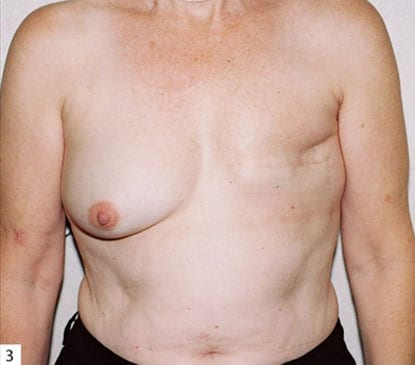Breast Reconstruction 08 Before Photo