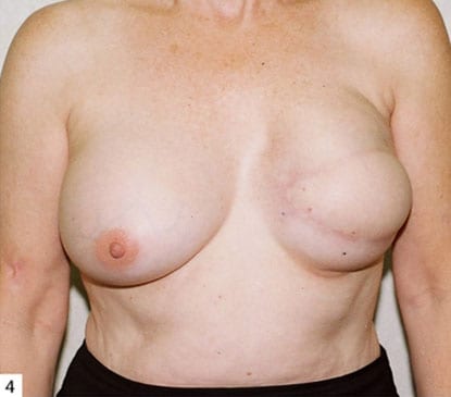 Breast Reconstruction 08 After Photo