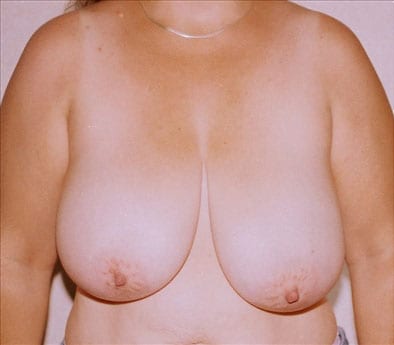 Breast Reduction 02 Before Photo