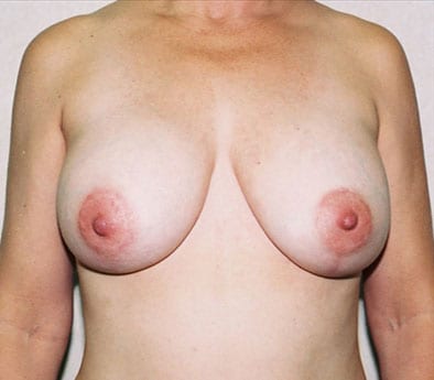 Breast Reduction 03 After Photo