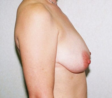 Breast Reduction 03 Before Photo
