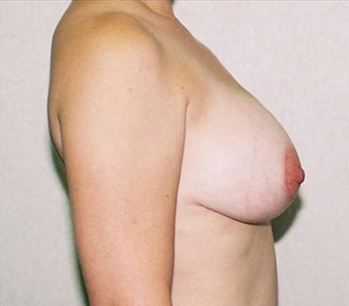 Breast Reduction 03 After Photo