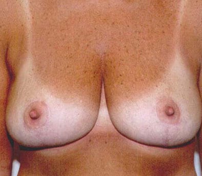 Breast Reduction 04 After Photo