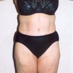 Liposuction 02 After Thumbnail Photo