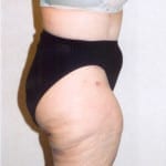 Liposuction 02 Before Thumbnail Photo
