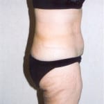 Liposuction 02 After Thumbnail Photo