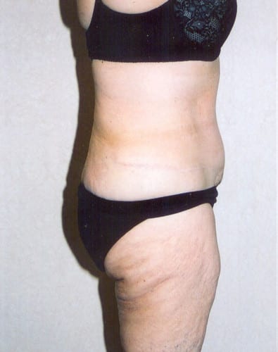 Liposuction 02 After Photo
