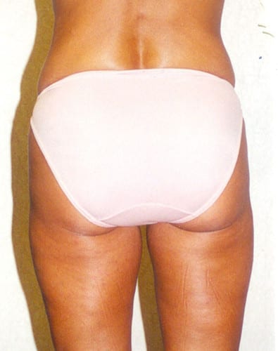 Liposuction 03 After Photo