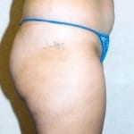 Liposuction 04 Before Thumbnail Photo