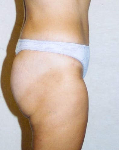 Liposuction 04 After Photo