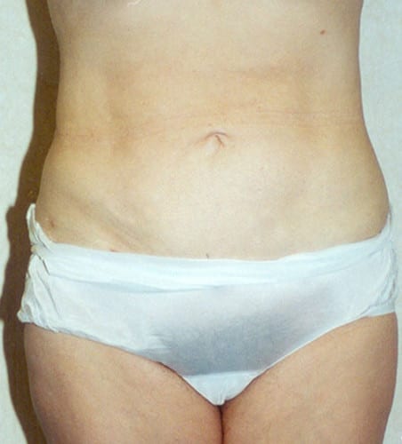 Liposuction 07 After Photo