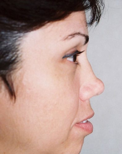 Rhinoplasty 05 Before Photo