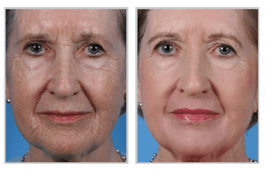 Treatment with the Sciton® Laser