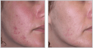 Laser Acne Treatments