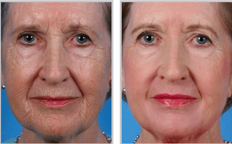 Sciton Laser Skin Resurfacing StLouis - Fractional Dermal Treatment Missouri