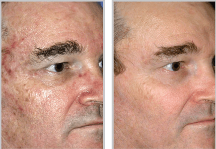 Skin Resurfacing Using the Sciton Laser Robert Wald MD