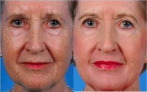 Before and After Laser Skin Resurfacing