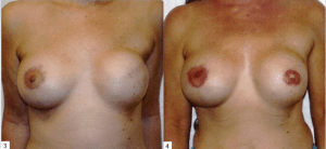 Breast Reconstruction Before and After