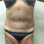 Abdominoplasty 07 After Thumbnail Photo