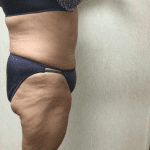 Abdominoplasty 07 After Thumbnail Photo