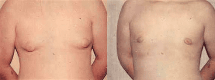 Before and After Gynecomastia Surgery