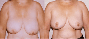 Before and After Breast Reduction