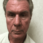 Male Cosmetic Surgery 10 After Thumbnail Photo