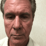 Male Cosmetic Surgery 10 Before Thumbnail Photo