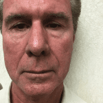 Male Cosmetic Surgery 10 Before Thumbnail Photo