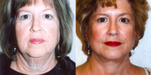 Before and After Facelift Surgery