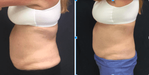 before-and-after-sculpsure