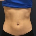 Sculpsure 01 After Thumbnail Photo