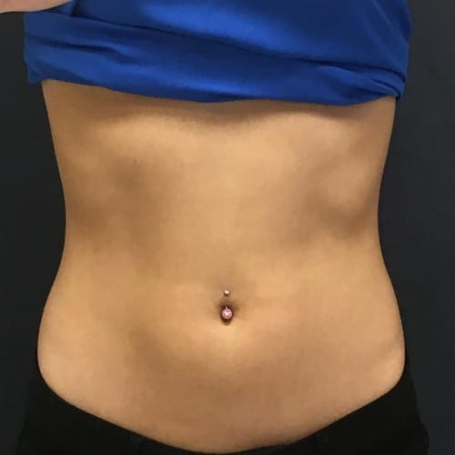 Sculpsure 01 After Photo