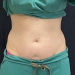 Sculpsure 02 After Thumbnail Photo