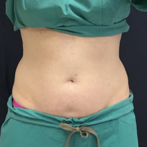 Sculpsure 02 After Photo