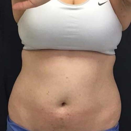 Sculpsure 03 Before Photo