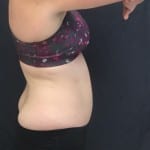 Sculpsure 03 After Thumbnail Photo